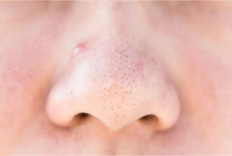 What is causing blackheads